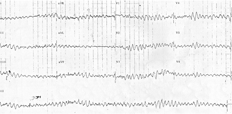 VF không bao giờ cần chẩn đoán từ ECG 12 đạo