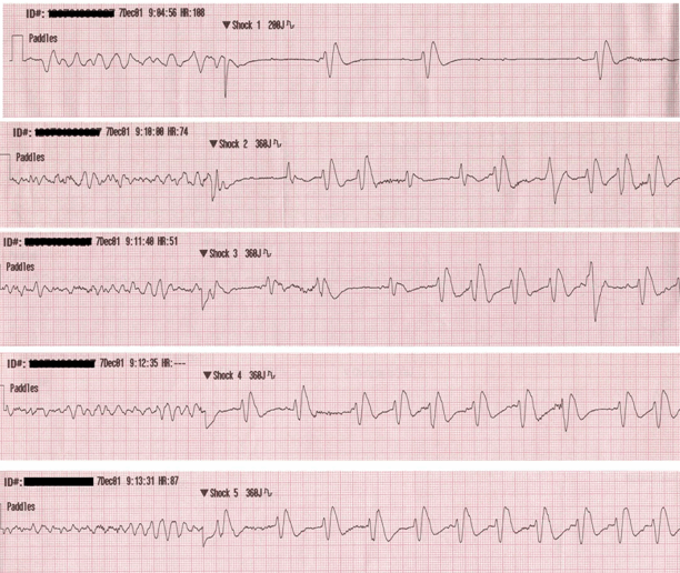 Bệnh nhân VF được sốc điện